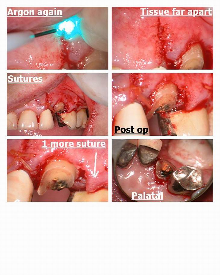 Resize of Osseous Recontouring on Canine pg 3.jpg